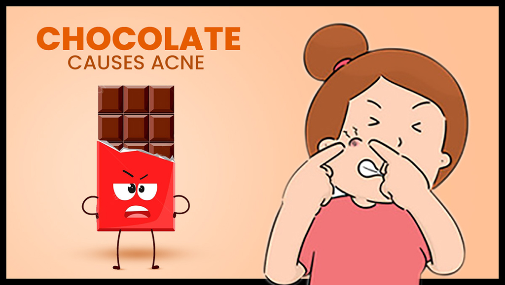 Chocolate causes acne